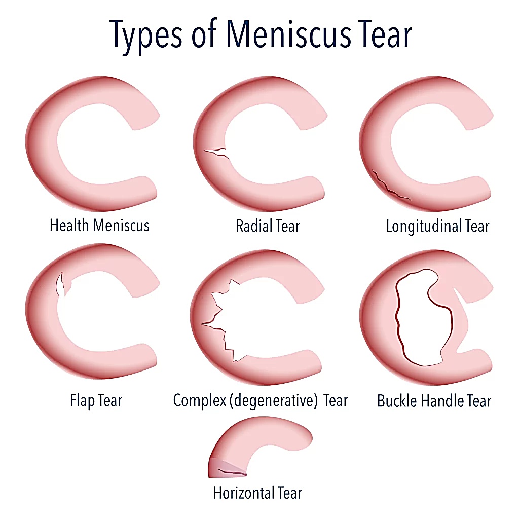 Diagram showing the seven types of meniscus tear: healthy meniscus, radial, longitudinal, flap, complex, bucket-handle, and horizontal