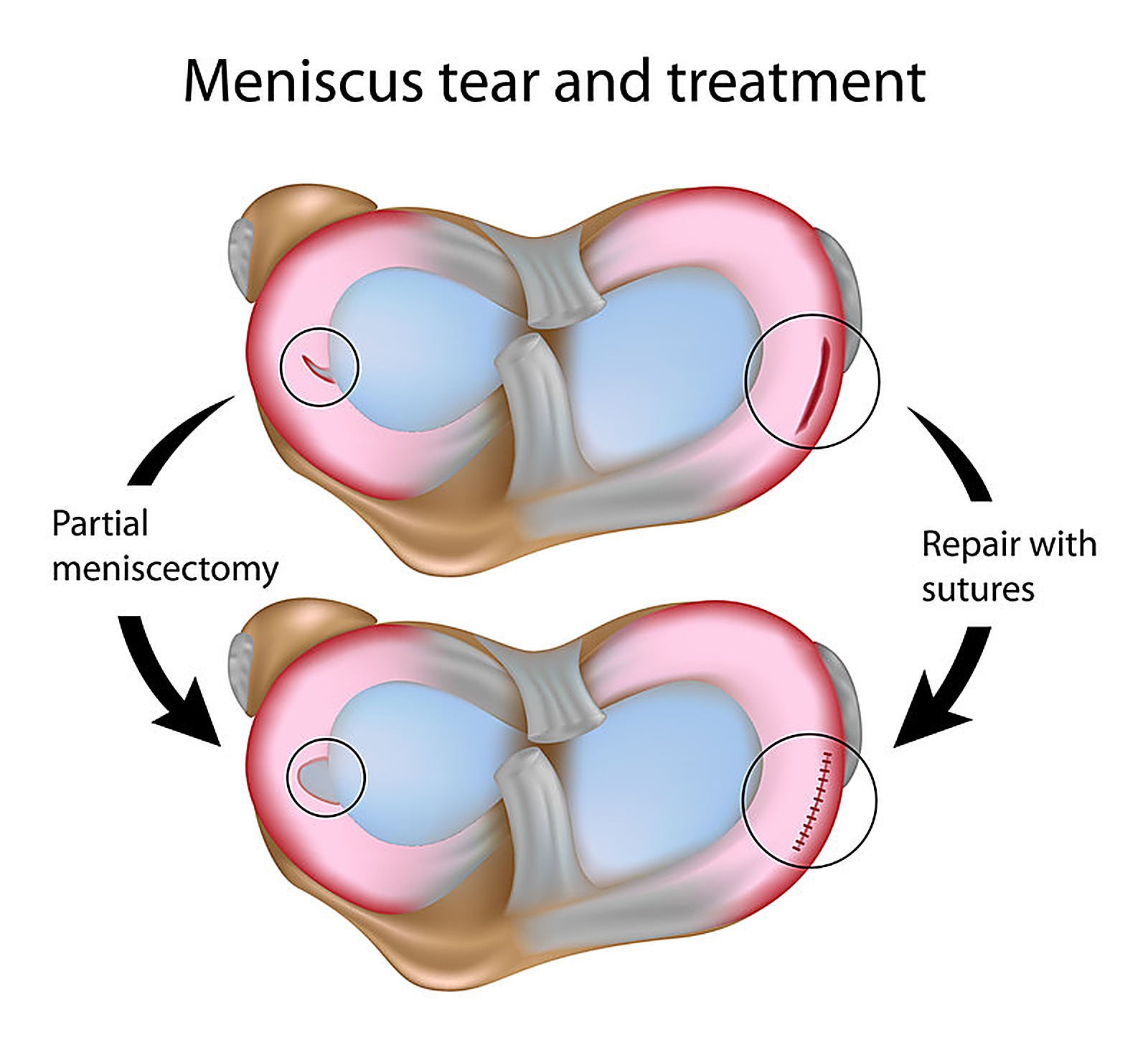 Meniscal Tear Treatment: Conservative vs Surgical