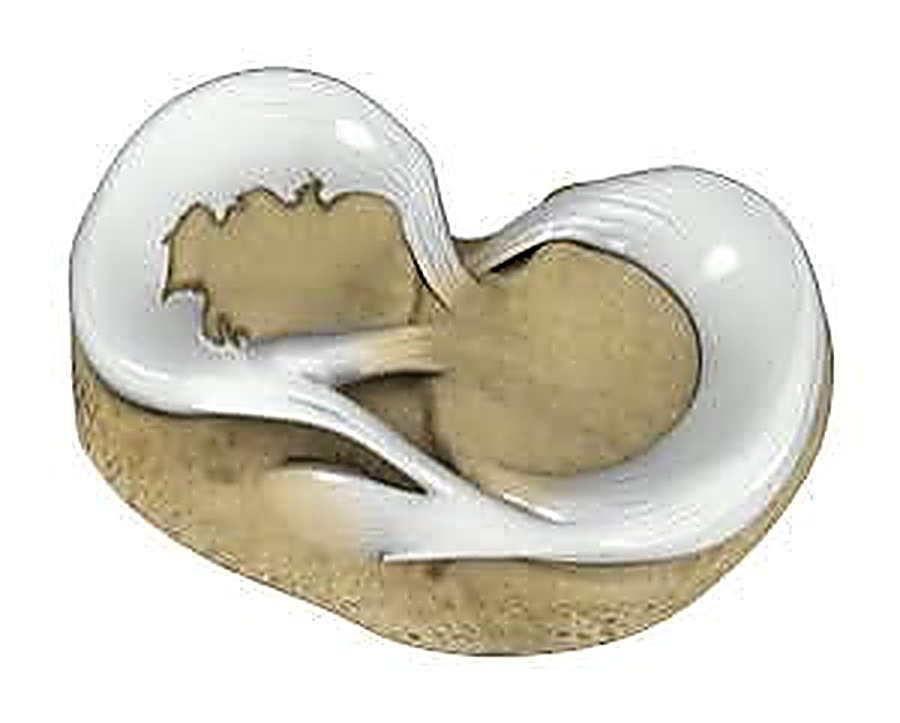 Degenerative Meniscal Tears: Do You Actually Need Surgery?
