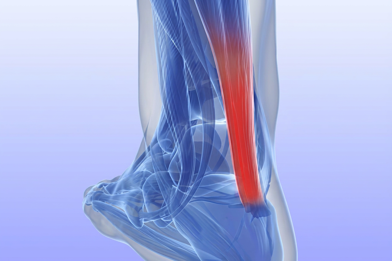Achilles Tendinopathy: Types and Rehab Differences