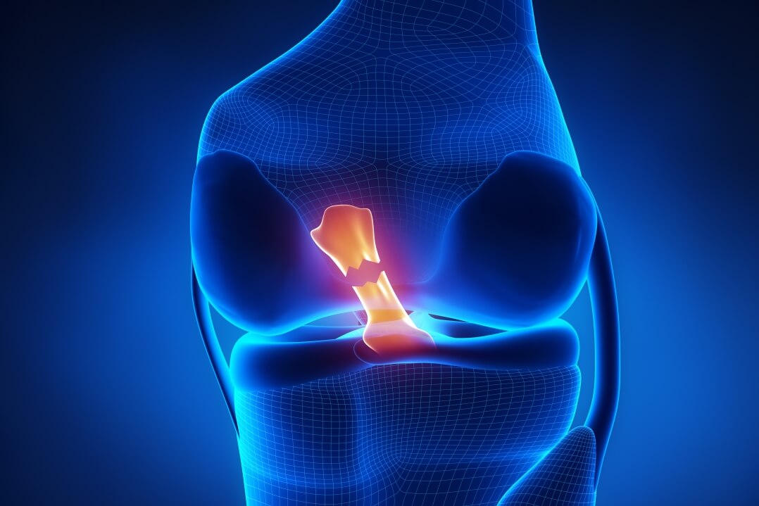 Ruptured Your ACL: What to Expect After Reconstruction