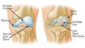 Osteoarthritis: What Can We Do to Delay Symptoms?