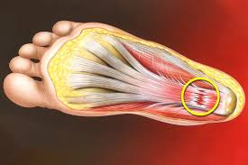Plantar Fasciitis: Understanding Heel Pain